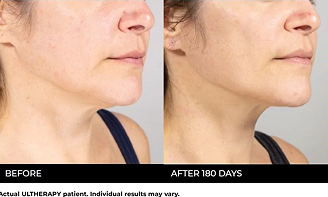 One Session Long Lasting Results