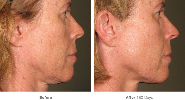 before_after_ultherapy_results_full-face15