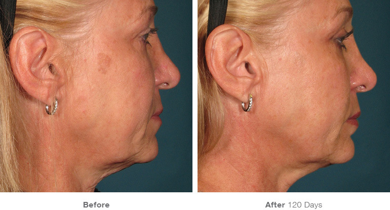 before_after_ultherapy_results_full-face5