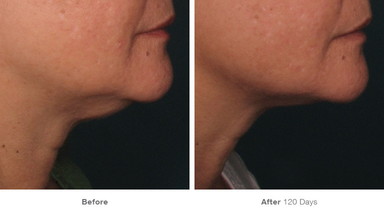 before_after_ultherapy_results_under-chin1