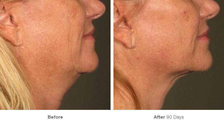 before_after_ultherapy_results_under-chin30