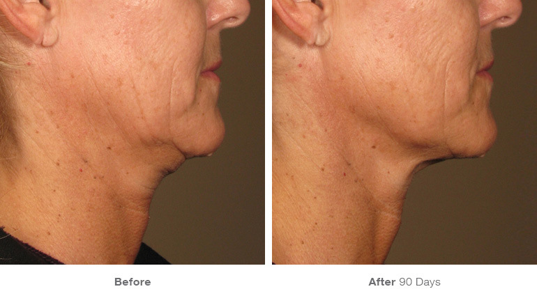 before_after_ultherapy_results_under-chin8