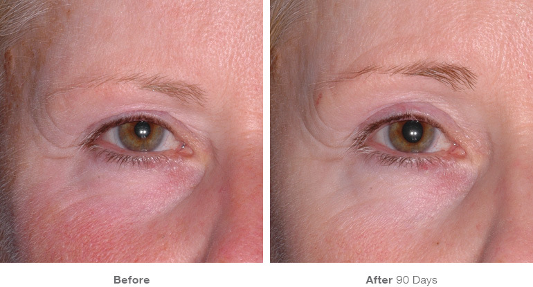 img_template_beforeafter_brow14