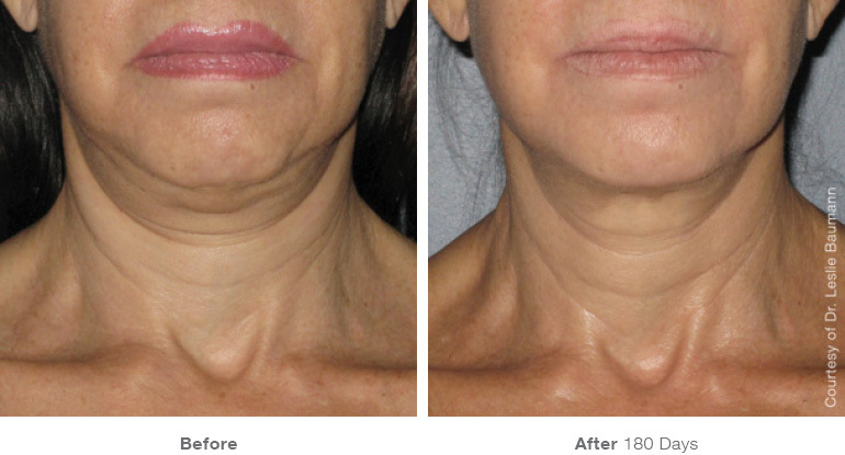 ultherapy-0008-0086w_180day_1tx_neck1_gallery