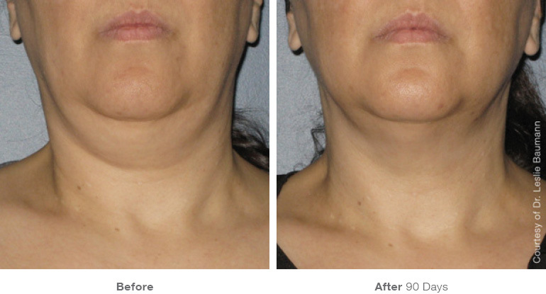 ultherapy-0014-0086w_90day_1tx_neck_gallery
