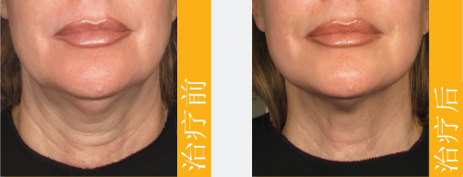 Pre Post Treatment Zh