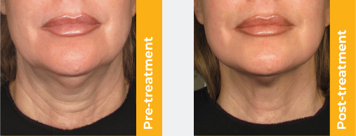 Pre Post Treatment